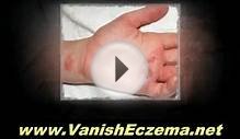 Skin Rash Eczema - Avoid Milk Products to Cure Eczema